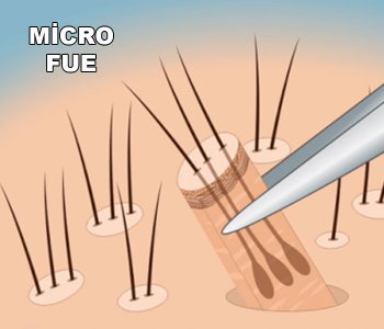 MICRO-FUE HAIR TRANSPLANT